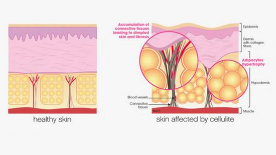 Image Title Skinade Targeted Solutions - Cellulite